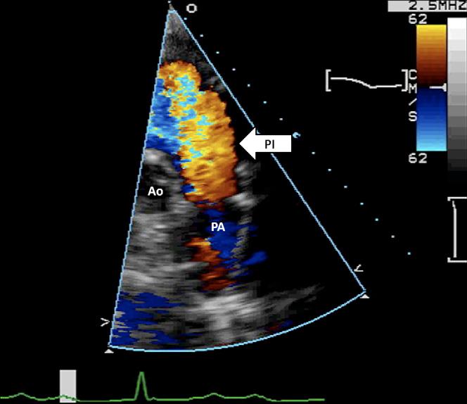 1072 Jhaveri et al Journal of the American Society of Echocardiography October 2010 Abbreviation PI = Pulmonic insufficiency findings of severe PI among our study patients.