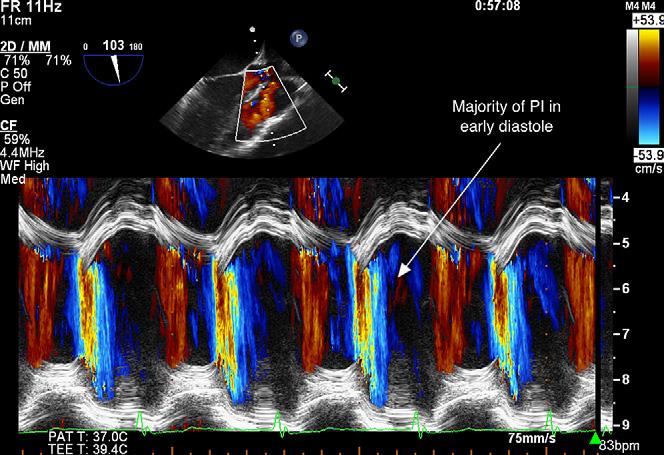 Journal of the American Society of Echocardiography Volume 23 Number 10 Jhaveri et al 1073 Figure 3 Color Doppler M-mode on transesophageal echocardiography reveals that the majority of PI occurs