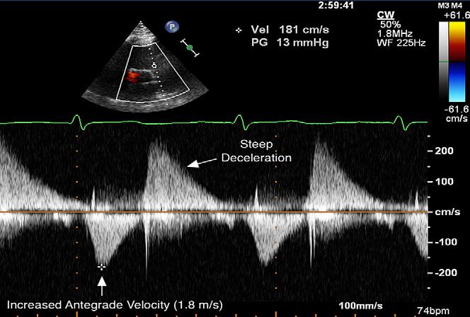 Figure 4 Continuous-wave Doppler through the pulmonic valve obtained by transthoracic echocardiography shows increased antegrade velocity through the pulmonic valve.