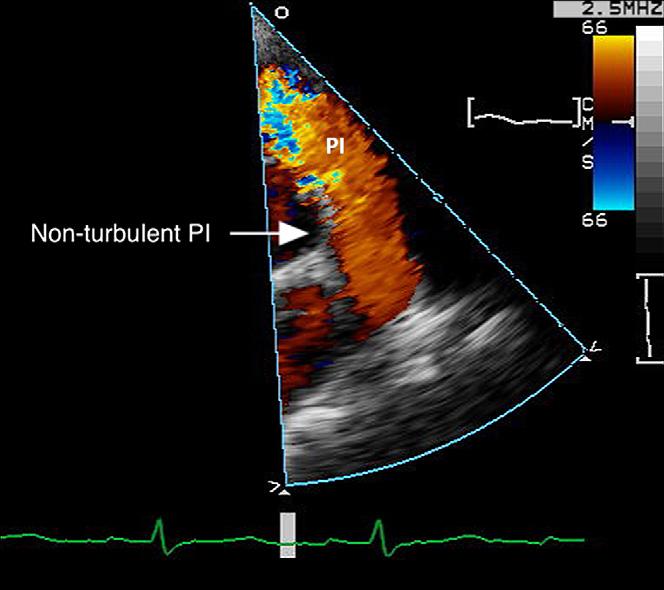 The low peak velocity is the result of a lowpressure gradient between the pulmonary artery and the right ventricle in early diastole.