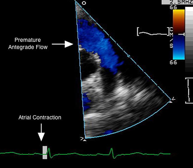 1074 Jhaveri et al Journal of the American Society of Echocardiography October 2010 Figure 7 Color Doppler obtained by transthoracic parasternal short-axis view at the basal level reveals premature