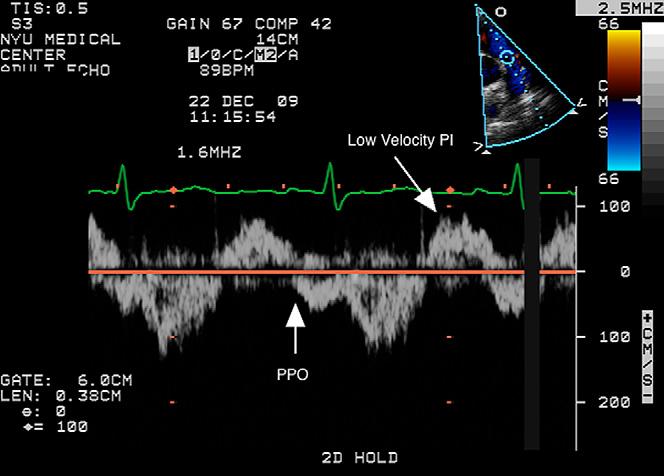 Figure 9 Continuous-wave Doppler through the tricuspid valve obtained by transthoracic echocardiography demonstrates premature closure of the tricuspid valve (PTC).