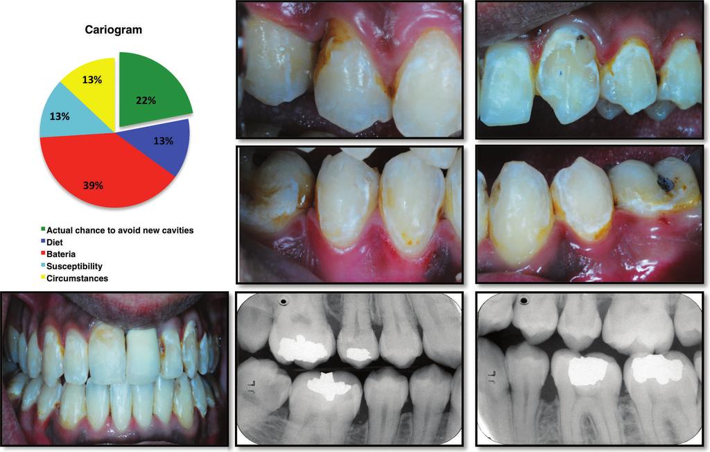 272 ALMOSA, AL-MULLA, BIRKHED Figure 3. This 23-year-old male patient consumes a maximum of 5 meals/d and uses fluoride toothpaste infrequently (3 times/wk).