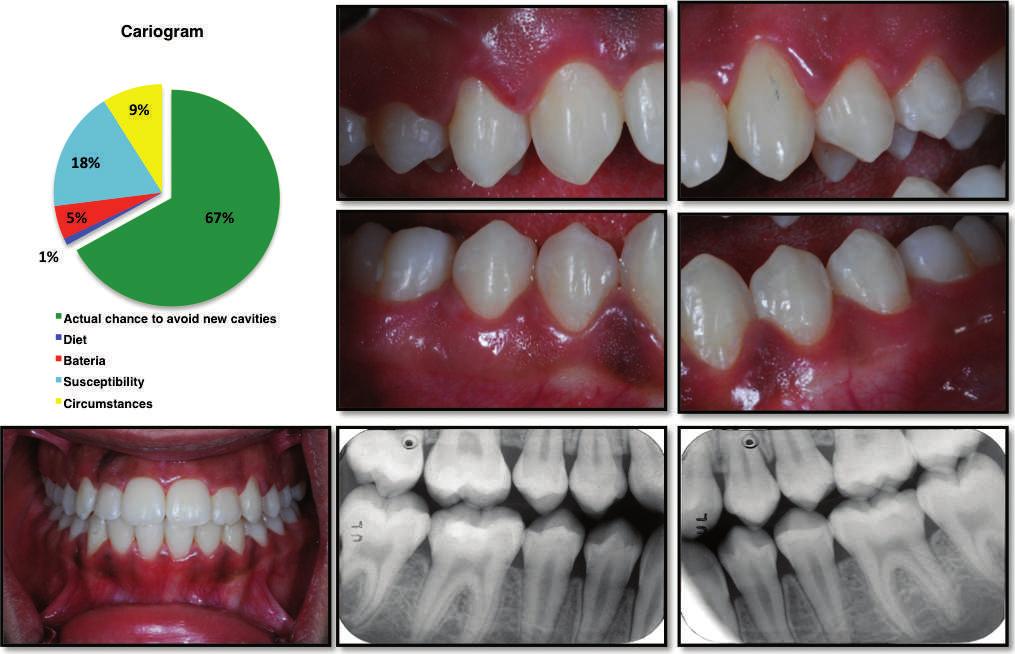 CARIES RISK IN GOVERNMENTAL AND PRIVATE PATIENTS 273 Figure 4. This 22-year-old male patient consumes a maximum of 3 meals/d and uses fluoride toothpaste frequently (2 times/d).