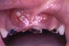 Early Childhood Caries A severe, rapidly