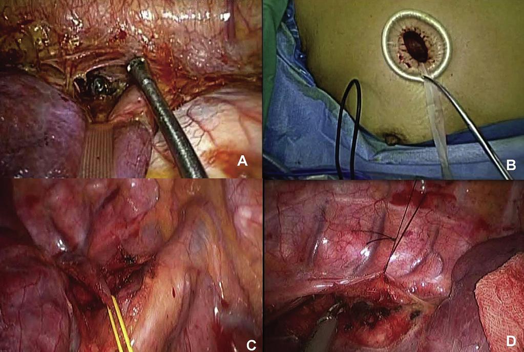 Ann Thorac Surg WANG ET AL 2013;96:977 82 SINGLE-PORT THORACOSCOPIC RESECTION 979 Fig 1. (A) A 4-cm incision was made over the anterior axillary line, over the sixth intercostal space.