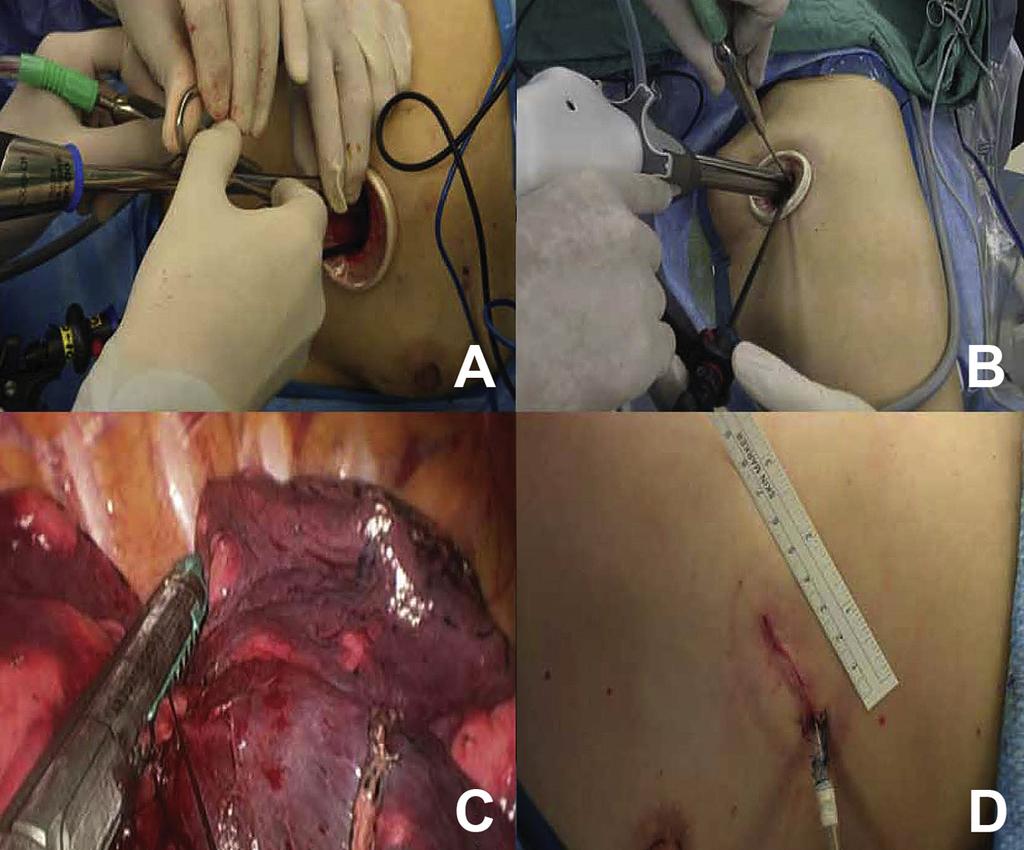 (B) The association between the endostapler and other instruments in the wound protector. (C) The bronchus was resected at the last stage of lobectomy by endostapler.