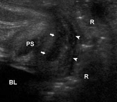 Vijayaraghavan Figure 3. Technique for perineal sonography in male patients through the portal posterior to the root of the scrotum. BL indicates urinary bladder; PS, pubic symphysis; and R, rectum.