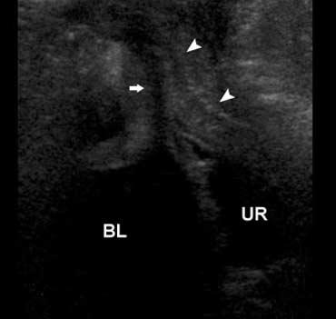 Perineal Sonography in Ectopic Ureteric Opening Into the Urethra Figure 6.