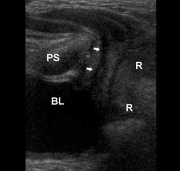 The ureter is shown opening into the proximal urethra (arrow). Figure 7. Perineal scan in an infant boy.