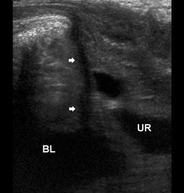 Perineal Sonography in Ectopic Ureteric Opening Into the Urethra systems. The dilated ureter is traced down, and causes such as ureterocele and primary megaureter are seen.