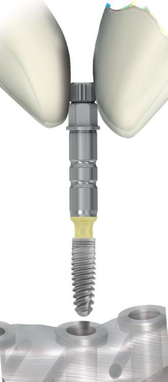 Implant Insertion C D Implant Insertion Insert the implant through the