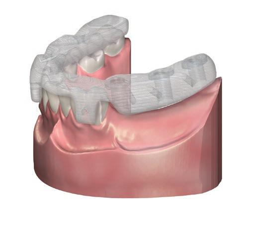 Pre-Surgical Steps 1 The package includes: A surgical template Final drills Multi-Unit abutments Implants Restoration Documentation