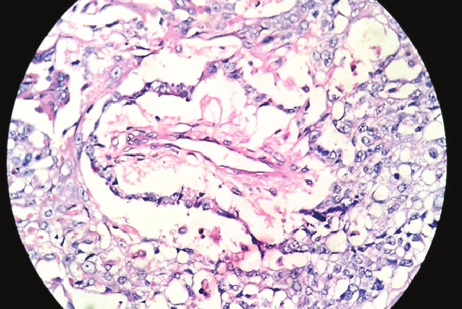 encountered of which majority were mature cystic teratomas. Malignant Germ cell tumors were seen in younger age group, and most frequent type was dysgerminoma.