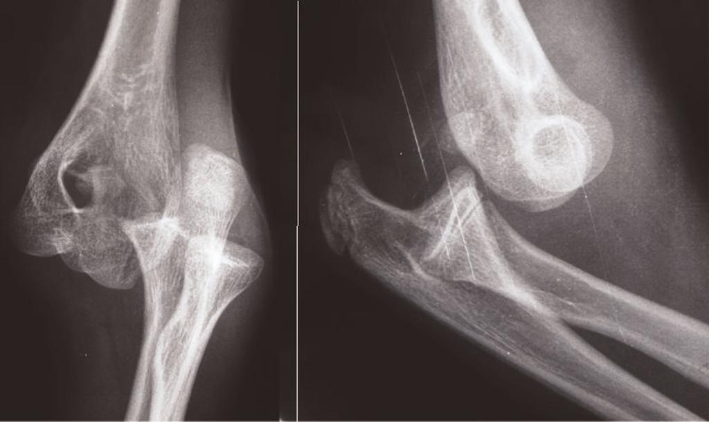 Figure 1. Radiographs showing a posterolateral dislocation of the elbow.
