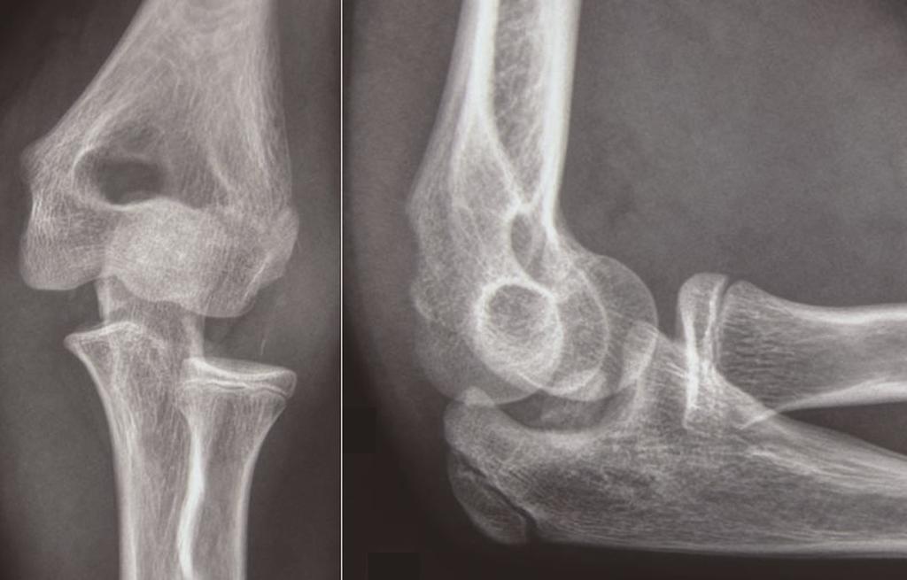 Radiographs performed after closed reduction.