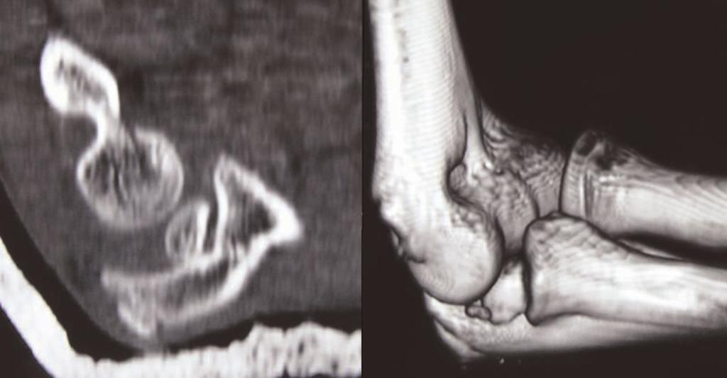 Figure 3. CT scan images. (A) Intraarticular fragment located into the humerocubital joint. (B) 3D reconstruction image. The fragment belonged to the medial epicondyle.