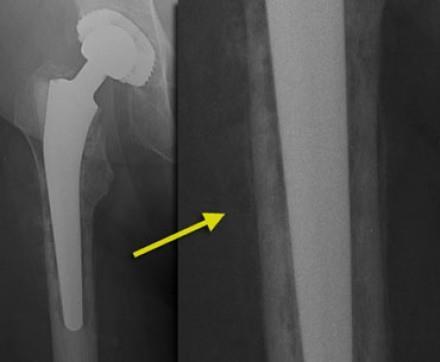 Wound Infection Hip Complications X Rays Not Helpful