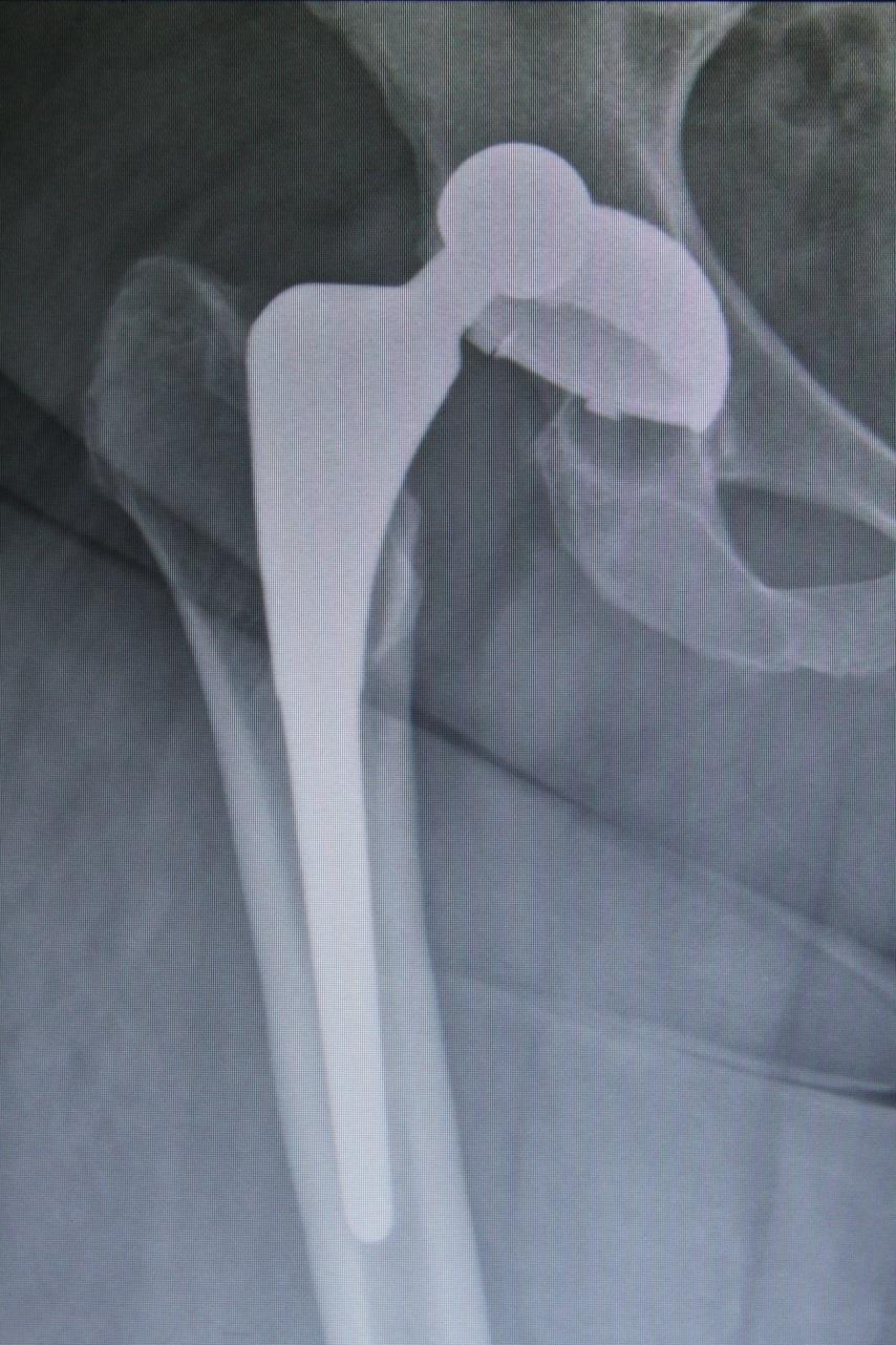 Dislocations Treatment Closed Reduction Hip