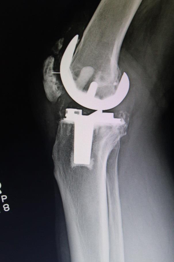 Knee Complications Patella Fracture Quads Intact
