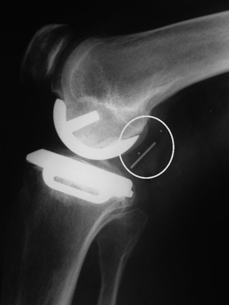 Knee Complications Unicompartmental Due to Flexion Extension Gap