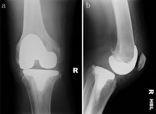Knee Complications Posterior Substituting TKA {PS} Posts of Various