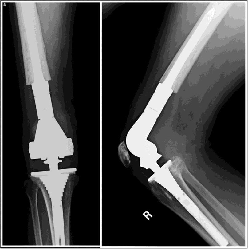 Knee Complications Periprosthetic Fractures Common Supracondylar Replace It