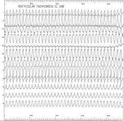 Amar Al-Hamdi et al., ARVD in Iraq Figure 1. Left bundle branch block pattern of ventricular tachycardia with superior axis. Cycle length of 248 ms (rate of 242 bpm).