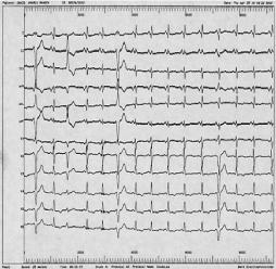 Cardiology Journal 2010, Vol. 17, No. 2 A B Figure 2. A. Twelve-lead electrocardiography showing T wave inversion in all the precordial leads; B. Magnified V2, V3 showing epsilon wave (arrow).