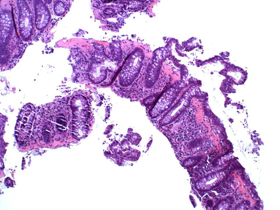 Pathology This shows how the superficial epithelium