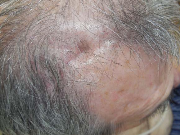 Distant (a) and closer (b) views show a depressed scar following repair of the scalp defect using a skin flap.