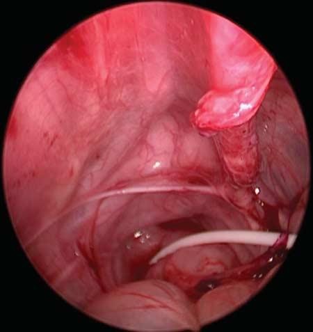 cases), abdominal distention and mass (four cases), recurrent inguinal swelling (four cases), and CSF discharge from the umbilicus or manifestations of increased intracranial tension (seven cases).