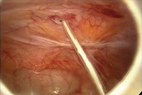 9 Umbilical fistula discharging