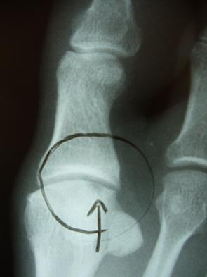 Microfracture Forms fibrocartilage Osteochondral Autograft Require harvest from other site Autologous