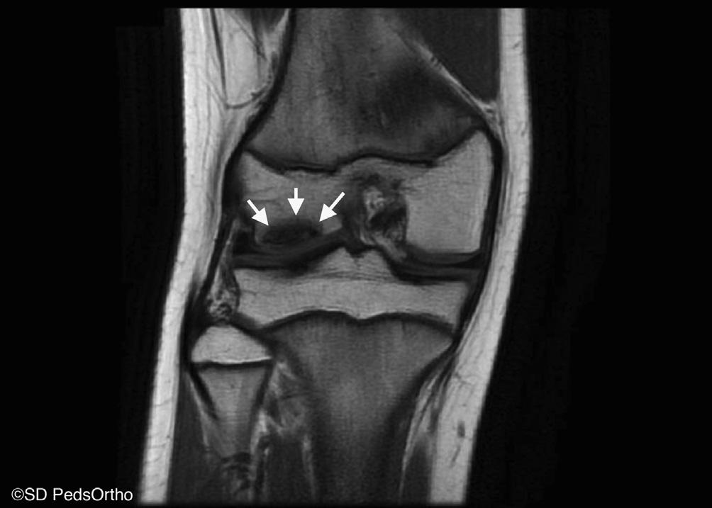 OCD DRILLING OF KNEE e233 Fig 3. The coronal magnetic resonance image confirms the presence of the OCD lesion and the sclerotic rim but shows no obvious breach of the overlying articular cartilage.