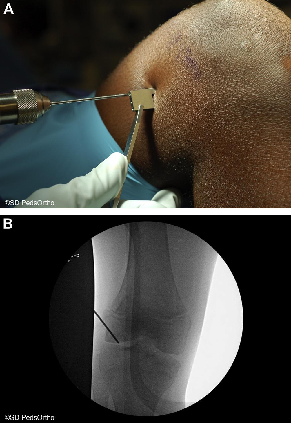 When the first Kirschner wire has been advanced to the center-center position of the OCD lesion just through the subchondral bone, but not through the articular cartilage, the Kirschner wire is cut