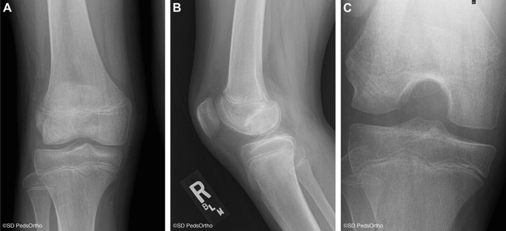 OCD DRILLING OF KNEE e235 Fig 7. (A) Anteroposterior, (B) lateral, and (C) Rosenberg views taken 6 weeks postoperatively show radiographic evidence of OCD healing.