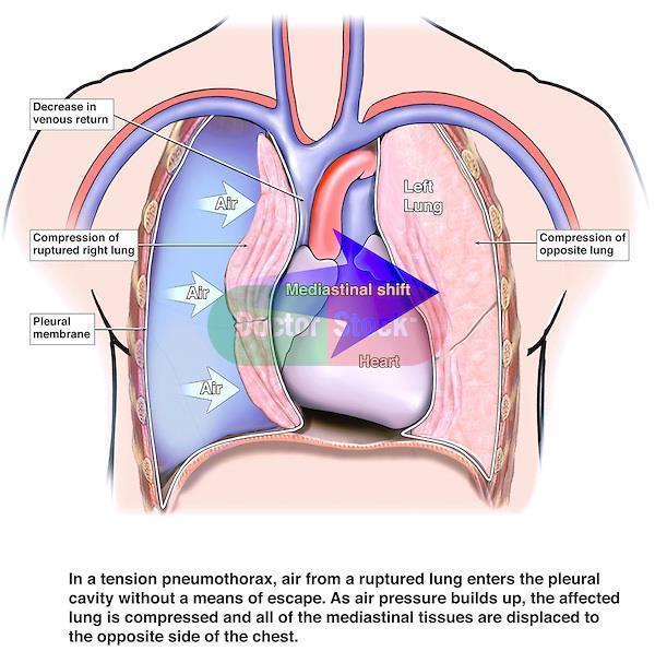 scattered white area<< thats mean there is of fibrosis in the lung *in pneumothorax you able to find black color compress the the small white area this small white area (collapsed lung) and the black
