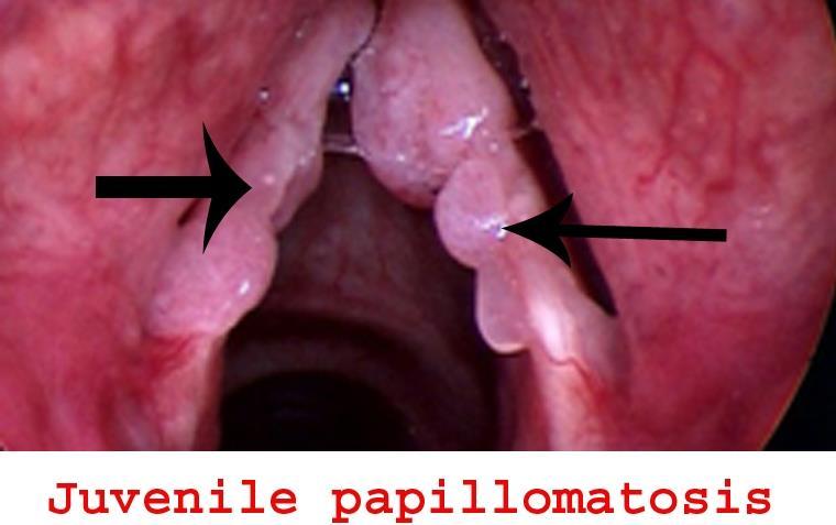 one mass with finger like projection reccurent: means exclusion of it lead to arise it again resoiratory : in respiratory system papillomatous : more than one papilloma mainly in