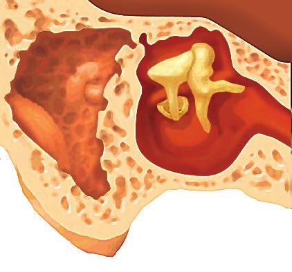 Mastoidectomy Mastoidectomy is a surgery where the cholesteatoma is removed together with part of the involved mastoid bone using a microscope and high-speed drills.