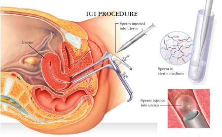 consider before deciding between IUI and IVF?