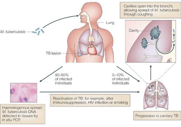 Pathogenesis of TB kids are different Risk of developing disease after exposure 43% <1 yr