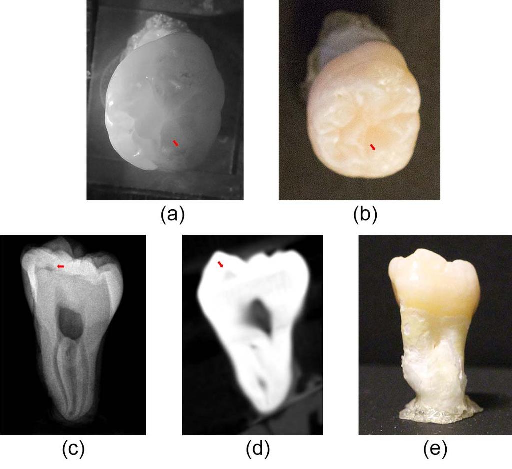 Figure 3. Images of extracted tooth sample 2. (a) NIR occlusal transillumination; (b) white light occlusal; (c) 2D radiograph; (d) CBCT radiographic slice; (e) white light. In the tooth in Fig.