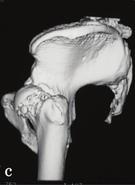 tomography (3DCT) with an anteroposterior view