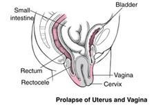com/women/uterine-prolapse) Uterovaginalis prolapsus (joonis 8): emaka prolaps koos tupega (Monga & Dobbs, 2011).