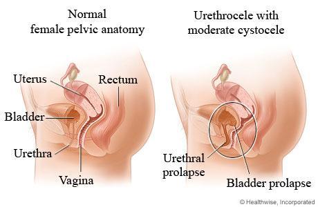 A B Joonis 2. Naise vaagnaorganite normaalne asend (A) ja urethrocele koos cystocele ga (B). (http://www.webmd.