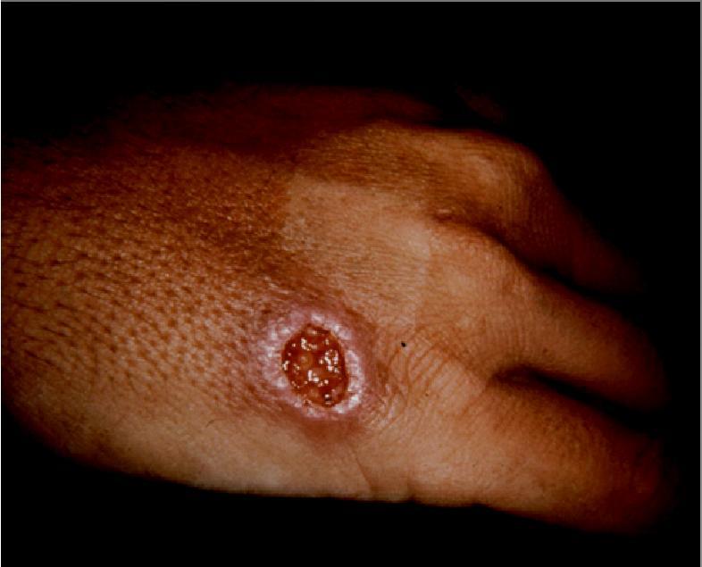 lesions (aka, localized or simple CL) Mucocutaneous