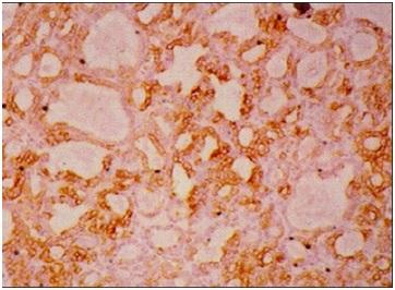cells showed positive immune staining for thyroglobulin and CK-19 and negative for calcitonin. Refer fig. 5 and fig 6 for HPE section showing medullary thyroid. Fig.