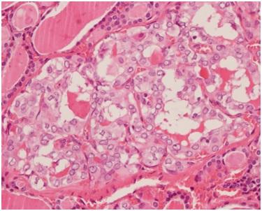 Fig. 7: HPE section showing papillary carcinoma with follicular or papillary carcinomas (showing immunoreactivity to thyroglobulin).