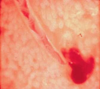 Hookworm-Blood Loss Adult worms injure their host